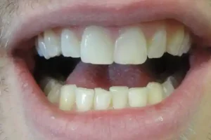 ציפויי-שיניים-אחרי