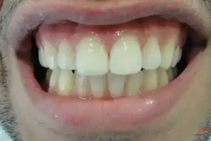 ציפויי-שיניים-אחרי