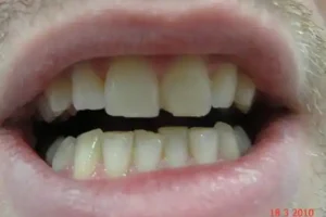 ציפויי-שיניים-לפני