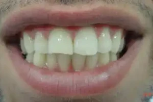 ציפויי-שיניים-לפני